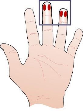 Blodsockerkontroll 1. Använd rena handskar 2. Tvätta patientens händer 3. Förbered material för blodsockerkontroll 4. Välj ring eller långfinger 5. Stasa fingret, inte mjölka.