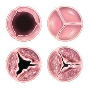 Vad är aortastenos? Hos en patient med aortastenos öppnas inte längre aortaklaffen helt. Öppningen är begränsad eftersom delar av klaffen blivit förträngda (minskat) över tiden.