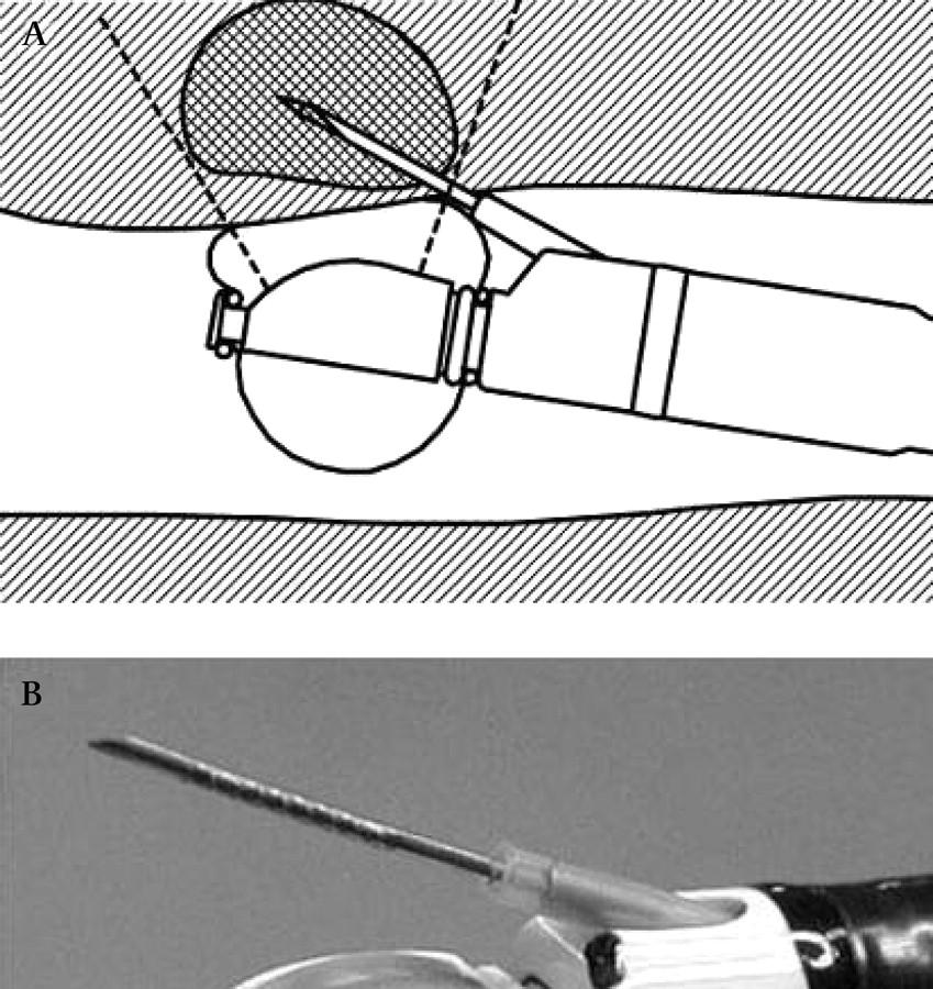 Procedur Ambulant i lokalanestesi + Midazolam i.v.