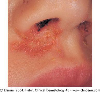 Impetigo