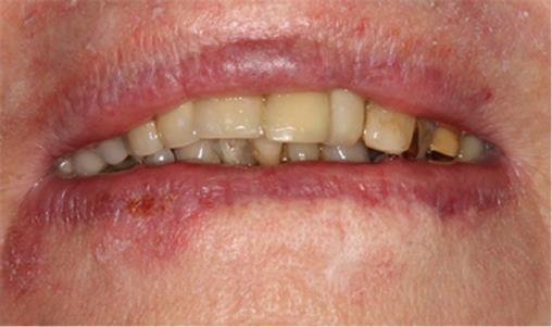 Munsår Vid muntorrhet får man lätt munsår Läkemedelsbiverkan i tandköttet Gingivala hyperplasier dvs tandköttet växer till onormalt