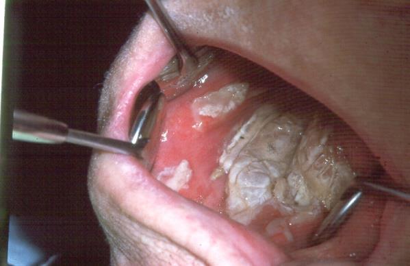 Sår på munslemhinnan www.lvn.se Antikoagulantia Många patienter äter blodförtunnande läkemedel.
