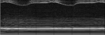 and be reflected back to the strongly reflecting structure and ultimately reach the transducer. This will lead to a false echo, which appears in the image behind the strongly reflecting structure. 2.