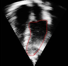 is mostly done by drawing the contours of the inner walls of the left ventricle in the end-systole respective the end-diastole by hand. This gives a highly subjective result.