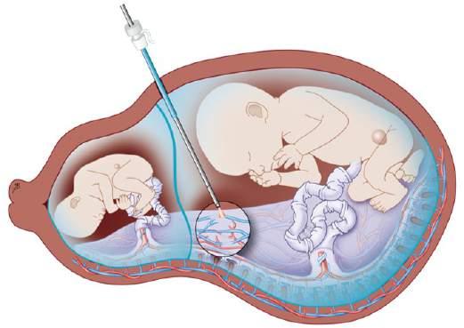 Poly/oligo (>8cm/<2cm SDP) u 2. Ej synlig urinblåsa hos donatorn u 3.