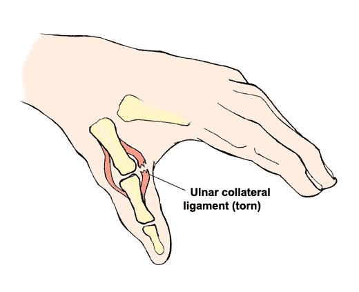 ULNAR