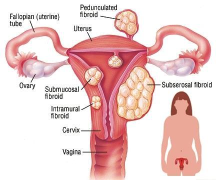 Undersökning- menorragi Allmänundersökning Gynekologisk undersökning: Titta efter polyper som sticker ut från cervix Känn