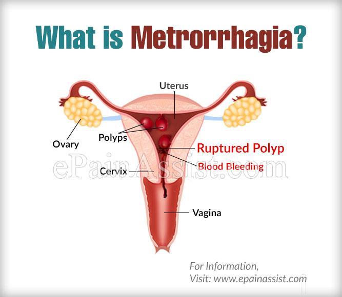 Differentialdiagnoser-metrorragi Omoget/instabilt hormonsystem Efter menarche eller förre menopaus Dysfunktionella uterinblödning Exclusionsdiagnos- stor