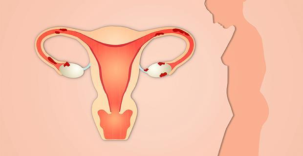 Endometriose DEFINITION: Förekomst av endometrievävnad utanför uteruskaviteten. FÖREKOMST: Prevalensen är 6 10 % av den generella kvinnliga befolkningen.