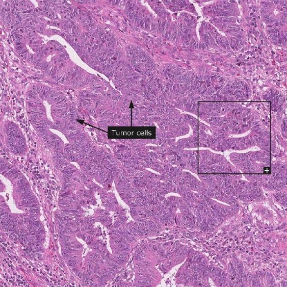 Regulatory T cells and mucosal-associated invariant T cells in colon