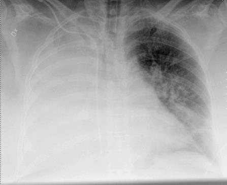 Klinisk diagnostik Lungröntgen är oftast förstahandsdiagnostik DT som tillägg om svårbehandlad