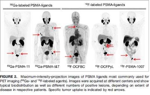 Novel tracers for PET imaging: Först radiosyntes och prekliniska studier Johns Hopkins University Sedan - Heidelberg group,psma-11 biodistribution