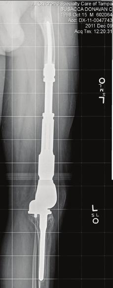 02 Fastställ magnetens och växellådans position inuti patientens lem. Se ritningen med patientspecifika åtgärder 2. Magneten och växellådan ska vara inriktade så att den är i mitten av magnetspolen.