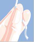 Misodel är en liten rektangulär plastbit innesluten in ett polyesternät. Plastbiten är en hydrogelpolymer som sväller i fuktig miljö för att frisätta en kontrollerad mängd misoprostol.