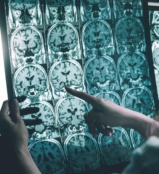BEHANDLINGSOMRÅDEN TERAPIOMRÅDEN MED STORA MEDICINSKA BEHOV BioArctic utvecklar nya innovativa behandlingar baserade på antikroppar (en form av immunterapi) mot neurodegenerativa sjukdomar som