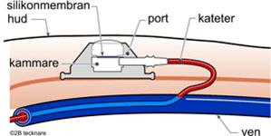 En subcutan venport är en centralvenös kateter som är kopplad till en dosa med en kammare och ett membran. Venport och kateter är ihopkopplade med en låsring och porten placeras subcutant (Bild 1).