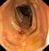 Infliximab (Remicade ) vid behandling av Crohns sjukdom