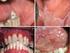 Oral lichen planus. Utredning och behandling av patienter med oral lichen planus och lichenoida kontaktreaktioner. Berörda enheter