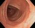 För behandling av icke-infektiösa inflammatoriska tillstånd i ögats främre segment.