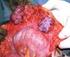 Epitelial Ovarialcancer