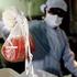Levertransplantation -