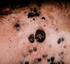 Malignt melanom svår klinisk diagnos