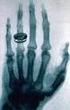RÖNTGEN. Röntgen tog världens första röntgenbild på en människa år Det var en bild av hans hustrus, Anna UPPTÄCKTEN